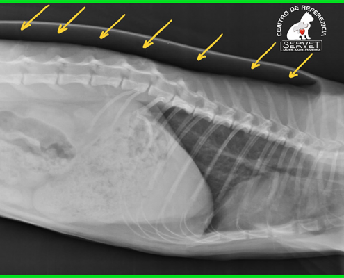 enfisema subcutáneo