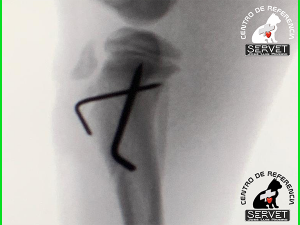 cirugia fractura tibia
