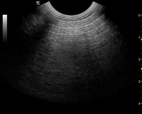 ecografía neumoperitoneo