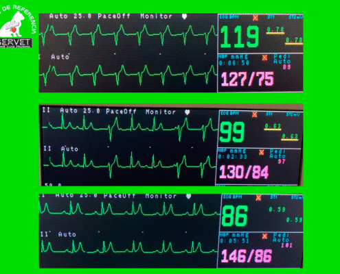 Taquicardia ventricular en servet urgencias