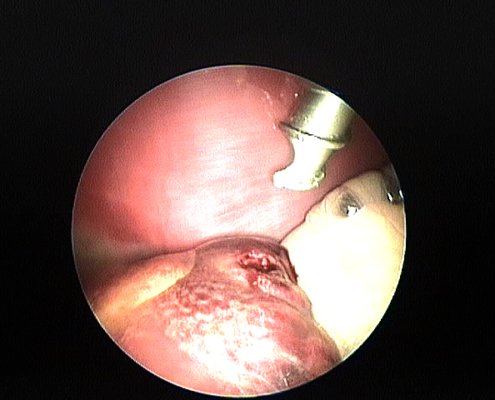 biopsia hepática por laparoscopia