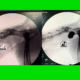 Fluoroscopia vesical con contraste