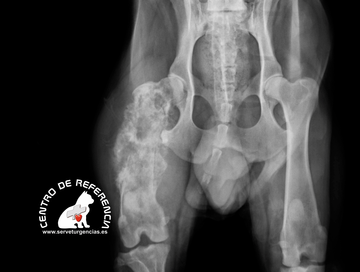 OSTEOSARCOMA-FEMUR OSTEOSARCOMA FEMUR