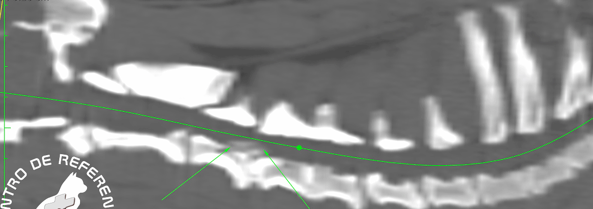 Hernia discal cervical slot ventral Hernia discal cervical slot ventral