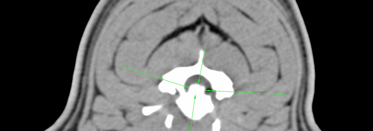 Hernia discal cervical Hernia discal cervical