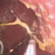 Endoscopia aguja estómago